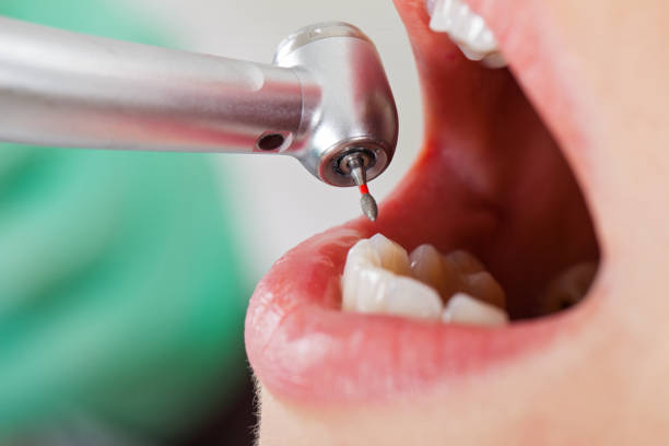 Best Emergency Tooth Extraction in Seven Fields, PA
